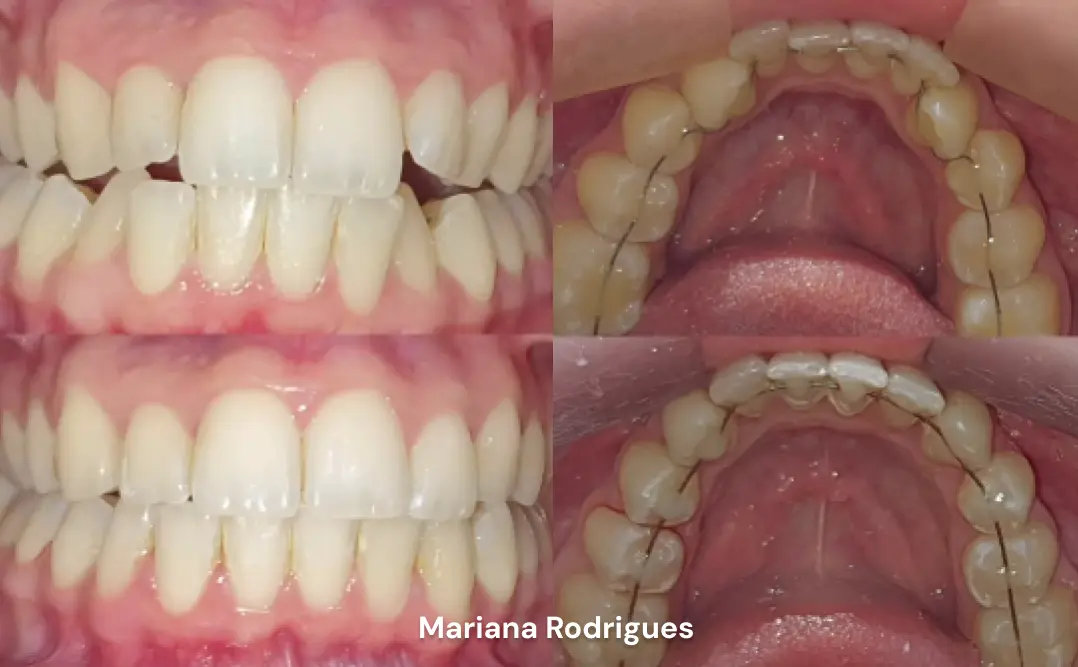 antes-depois-mariana-rodrigues